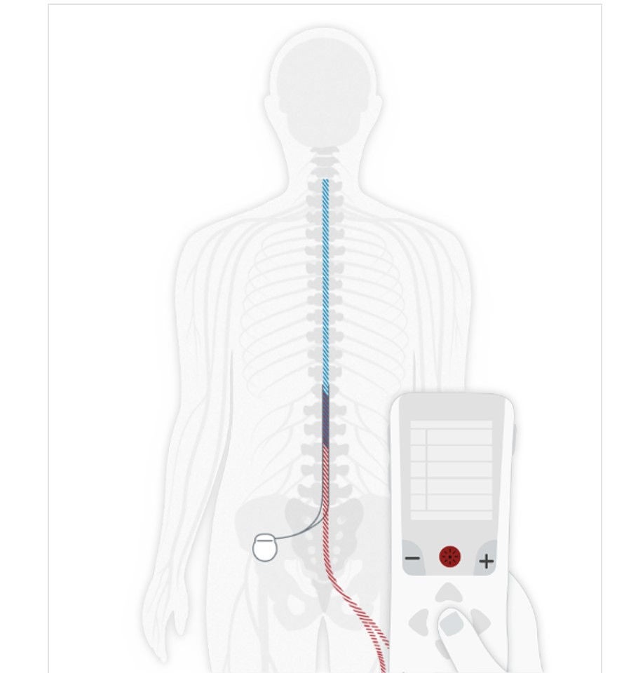 Diagrama que muestra el dispositivo de estimulación de la médula espinal con control remoto