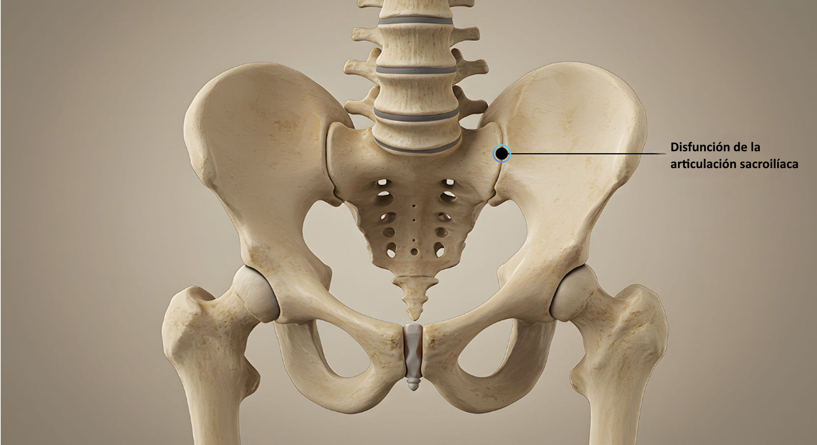 Disfunción de la articulación sacroilíaca