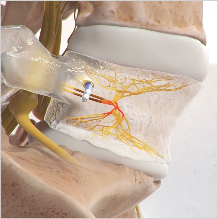 Detailed view of a spinal disc with a tool heating up the impacted nerve root. 