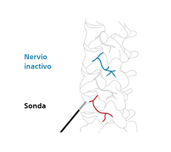 Ilustración que muestra cómo se inactiva el nervio