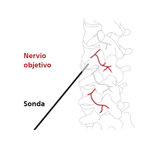Ilustración que muestra cómo se selecciona el nervio de manera específica